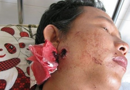 Công khai xin lỗi thanh niên bị truy tố oan sau khi trúng đạn - 2 Anh Huỳnh Nhật Quang lúc còn nằm viện sau khi bị trúng đạn tại trụ sở Công an xã Tắc Vân.