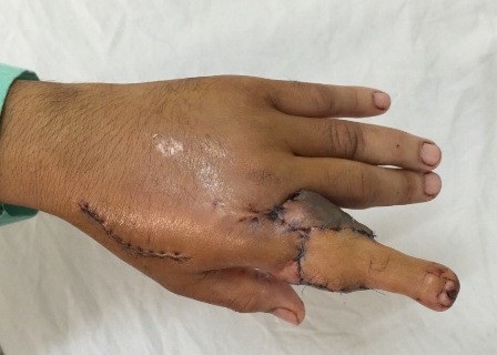 Ngón chân được ghép thành công trở thành ngón tay sau phẫu thuật