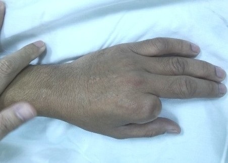 Ngón tay trỏ, bàn trái của bệnh nhân bị cụt trước khi ghép