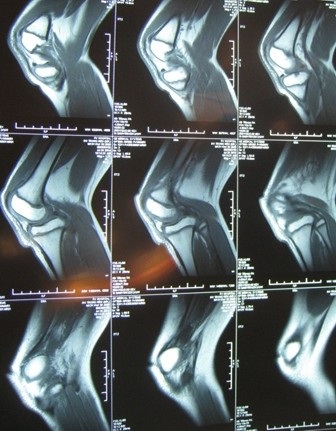 Hội chẩn quốc tế, phẫu thuật cứu đôi chân dị tật hiếm gặp - 1