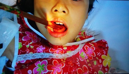 
Bệnh nhân nhập viện trong tình trạng đôi đũa xuyên rách lưỡi, găm chặt trong miệng
