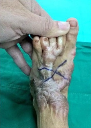 Dùng vạt da bụng cứu bàn chân bỏng nặng cho bệnh nhi - 1 Bàn chân của bé Tấn B. bị sẹo lồi, co rút do tai nạn bỏng lửa