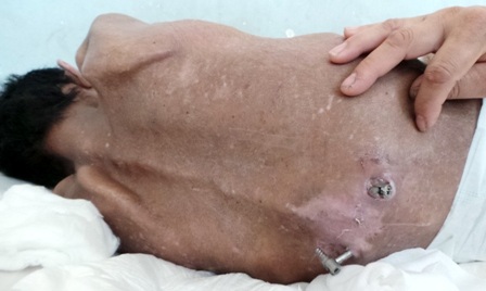 
Hai đinh vít nẹp cột sống đã đâm thấu thịt da, lòi ra ngoài
