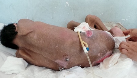 
Những vùng lở loét, nhiễm trùng trên lưng, mông và hai cánh xương chậu
