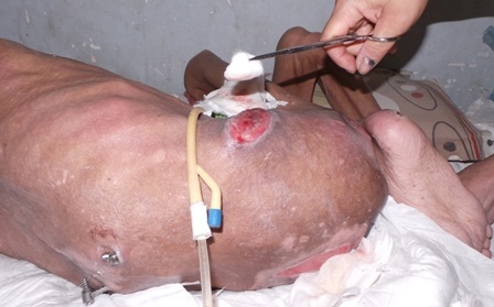 Cảnh "sống không bằng chết" của người đàn ông gặp tai nạn lao động thương tâm - 6