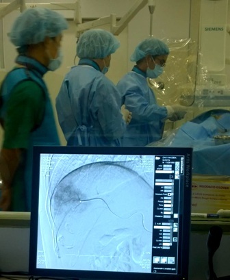 
Phương pháp nút hóa chất động mạch lần đầu tiên được thực hiện tại bệnh viện tuyến quận huyện.
