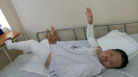 Nữ nhân viên y tế đang được điều trị tại khoa Bỏng, bệnh viện Chợ Rẫy