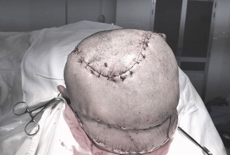 Vùng da đầu của người bệnh sau phẫu thuật