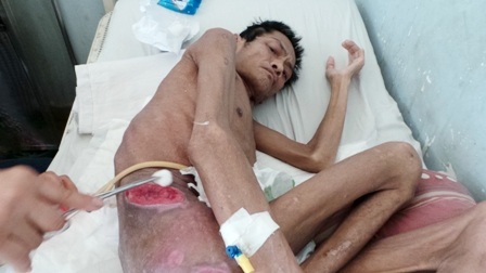 Người bệnh sẽ đối mặt với tình trạng nhiễm trùng, nguy cơ tử vong cao trong quá trình điều trị