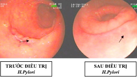 Người bệnh cần tuân thủ phác đồ điều trị để có kết quả tốt nhất, tránh tình trạng kháng thuốc