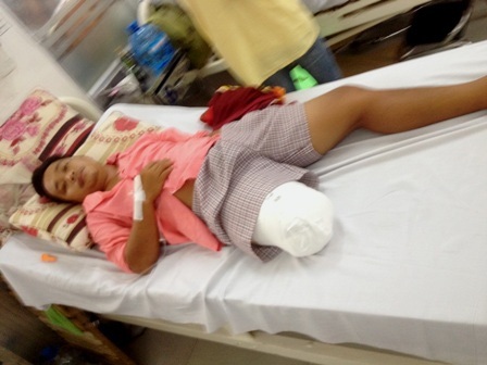 
Bệnh nhân Hoàng Lâm đã bị cắt cụt một chân do tắc động mạch khoeo gây hoại tử
