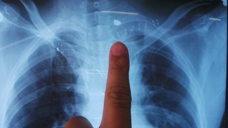 Viên đạn còn nằm lại trong vùng trung thất của bệnh nhân