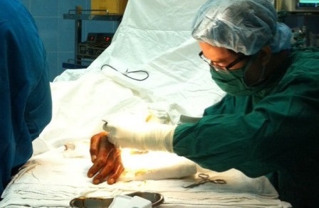 4 tiếng vi phẫu nối liền bàn tay bị cưa máy chém đứt lìa - 2 Sau 4 tiếng vi phẫu, bác sĩ đã nối thành công bộ phận bị đứt lìa cho bệnh nhân