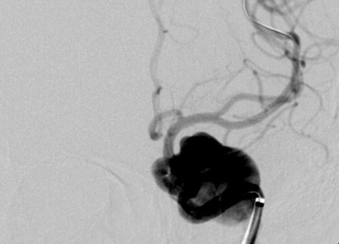 Hình ảnh cho thấy túi phình mạch máu não không lồ bệnh nhân Diễm T. gặp phải