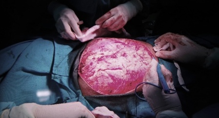 Bé gái 10 tuổi đã được "giải thoát" khỏi bướu rùa nặng hơn 1kg - 3