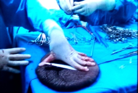 Bé gái 10 tuổi đã được "giải thoát" khỏi bướu rùa nặng hơn 1kg - 4