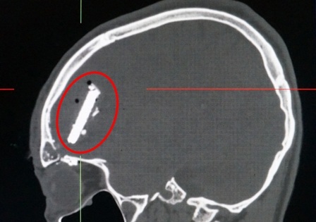 Lưỡi cưa xuyên vỡ hộp sọ nằm trong não nạn nhân
