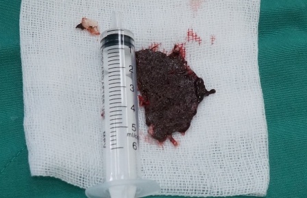 
Mảnh lưỡi cưa được lấy ra sau phẫu thuật
