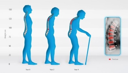Khám, tư vấn miễn phí bệnh loãng xương - 1 Bệnh loãng xương có thể phòng ngừa hiệu quả bằng chế độ ăn uống, vận động khoa học