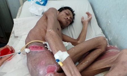 Hợp tác với Pháp nâng chất lượng chăm sóc điều trị vết thương - 1