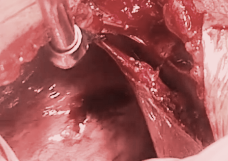 Bệnh viện quận cứu sống bệnh nhân bị đâm thủng tim - 1 Vết thương tim (vùng đen phía trong) đã được bác sĩ phẫu thuật khâu và cầm máu thành công