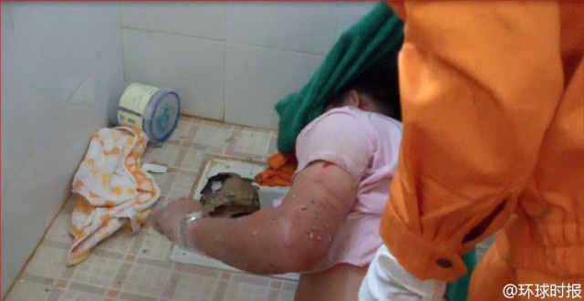 Kẹt tay trong bồn cầu cả đêm vì... cố cứu điện thoại bị rơi - 2 Mắc kẹt gần 5 tiếng trong bồn cầu khiến cánh tay người đàn ông này bị sưng phù.