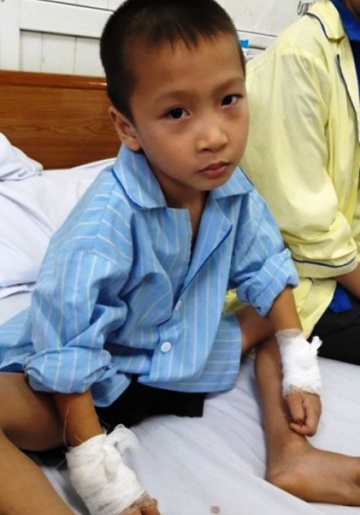 Vụ mổ nhầm tay trẻ 6 tuổi: Thành lập hội đồng chuyên môn và kỷ luật - 1 Bé Phạm Thành Luân bị BS mổ nhầm tay.