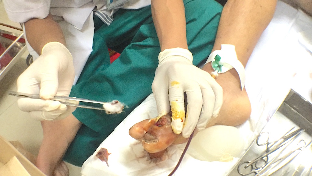 Nguy kịch tính mạng sau khi đá bóng bị toác chân - 1
Vết thương đơn giản ở ngón chân đã chuyển sang uốn ván.