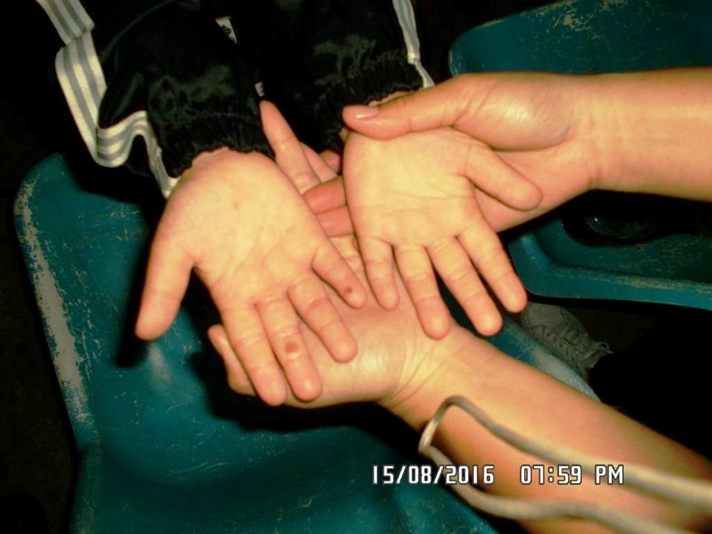 Nghi án bé gái 7 tuổi bị mẹ kế bạo hành - 2
Bàn tay cháu Th. còn bị nhiều vết bỏng là những đốm tròn.