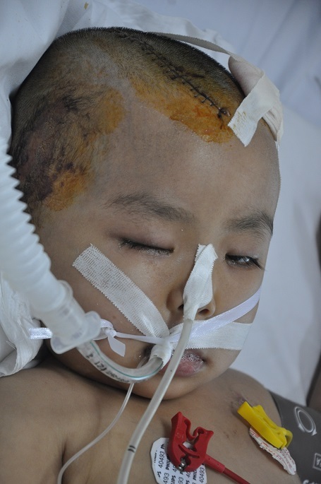 Bị chấn thương sọ não nặng, em đã được phẫu thuật lấy máu tụ tại bệnh viện Việt Đức.