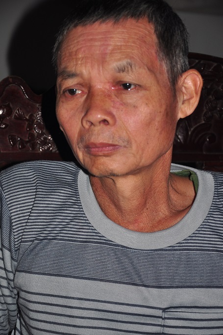 Ông nội của cháu bị ung thư xoang đã hơn 1 năm nay.