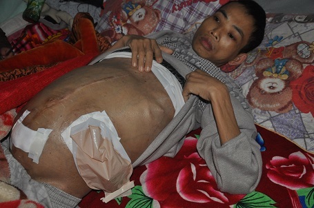 Bị ung thư trực tràng giai đoạn cuối khiến anh Thủy vô cùng đau đớn với cái bụng phình to.