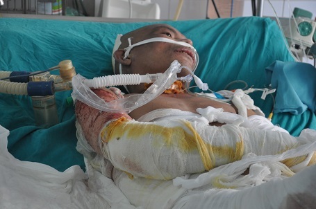 Bỏng đến 65%...