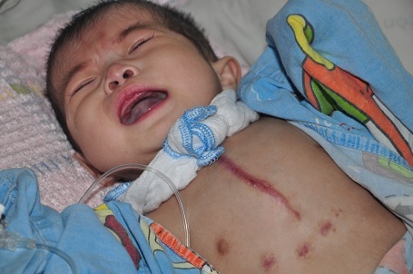 Cách đây 2 tháng bé được mổ để thay động mạch phổi nhân tạo nhưng giờ bị biến chứng, viêm nên phải mổ để thay lại.