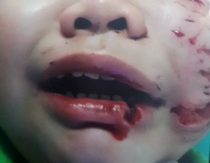 Tuần lễ khổ đau của những đứa trẻ và màn mù khô bất ngờ - 6 Trong lúc đùa giỡn với con chó ở nhà mình nuôi, bé Trần Trường T. (3 tuổi, ngụ tại huyện Củ Chi, TPHCM) bất ngờ bị chó cắn tới tấp, phải nhập viện khâu 200 mũi (Ảnh: Vân Sơn).