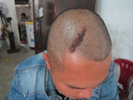 Anh Hiền bị vết chém dài trên đầu