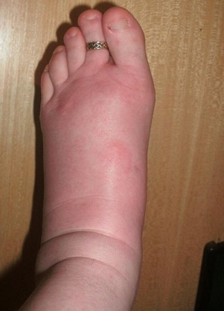 Đáng thương người phụ nữ dị ứng với hầu hết mọi thứ - 2 Đáng thương người phụ nữ dị ứng với hầu hết mọi thứ