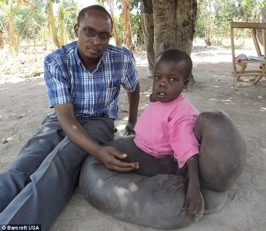 Sở hữu đôi “chân voi”, cậu bé chỉ được “diện” váy - 1 Sở hữu đôi “chân voi”, cậu bé chỉ được “diện” váy