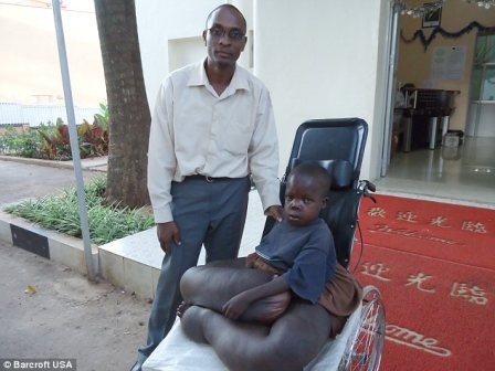 Sở hữu đôi “chân voi”, cậu bé chỉ được “diện” váy - 2 Sở hữu đôi “chân voi”, cậu bé chỉ được “diện” váy