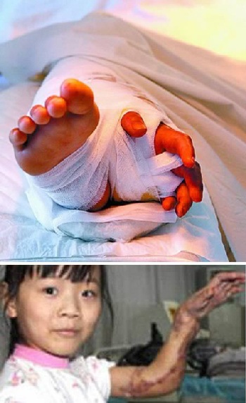 Bảo quản hộp sọ trong bụng