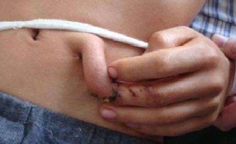 Bảo quản hộp sọ trong bụng