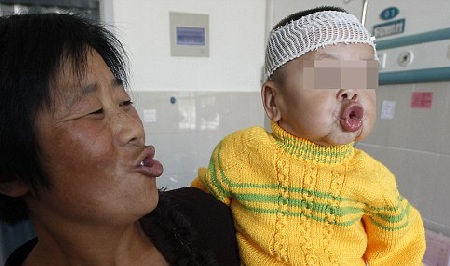 Bé gái 1 tuổi rưỡi có khuôn mặt già như bà lão - 1 Tuy có bệnh nhưng bé Yunxin vẫn rất hoạt bát