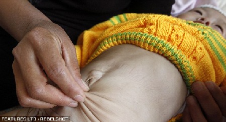 Bé gái 1 tuổi rưỡi có khuôn mặt già như bà lão - 2 Không những mặt mà các vùng da khác trên người bé đều bị chảy xệ