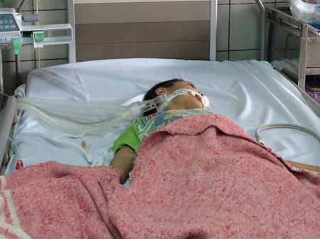 Bệnh nhi phải thở máy vì ngộ độc sau khi ăn sắn nướng. Ảnh: H.Hải