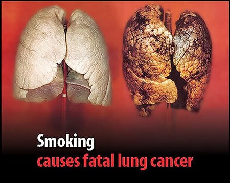 Các chất độc kinh hoàng có trong thuốc lá - 1 80% các ca ung thư phổi có liên quan đến thuốc lá