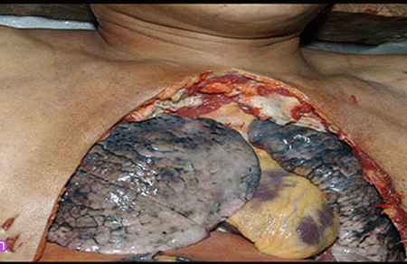 Hình ảnh phổi đen kịt vì chất độc từ thuốc lá.