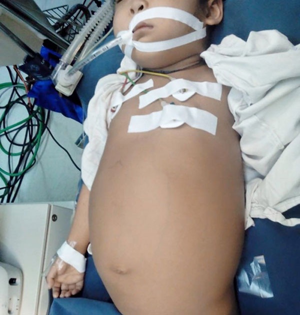 Bé gái 5 tuổi người Lào với bụng trướng to do u nang ống mật chủ. Ảnh: BS cung cấp