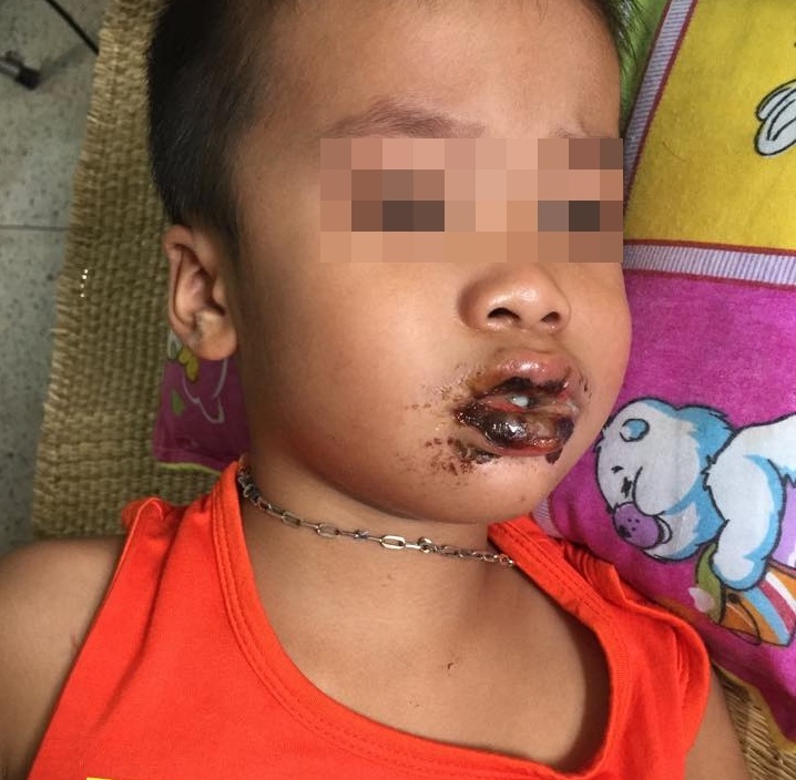 Nhầm bột thông cống là đường, 4 bé cùng nhập viện - 1 Bệnh nhi đang được theo dõi, điều trị tại BV.