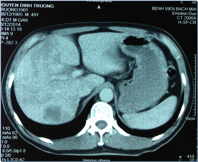 Hình ảnh khối u thu nhỏ còn 3,0 x 3.5cm sau điều trị bằng hạt vi cầu phóng xạ.