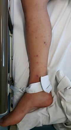Một thanh niên 21 tuổi hôn mê vì mắc não mô cầu - 2 Các ban hoại tử trên da của bệnh nhân. Ảnh: T.C